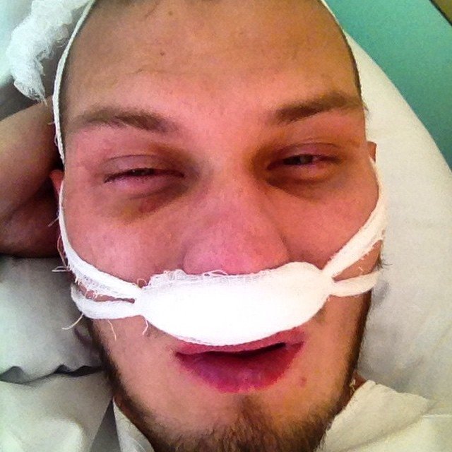 Артем Звягин попал в больницу с переломом носа