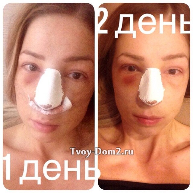 Надежда Ермакова решилась на пластику носа