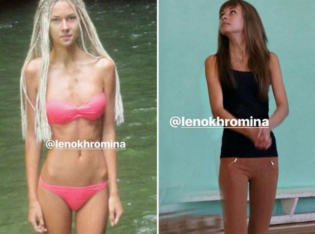 Елена Хромина призналась, что болела анорексией
