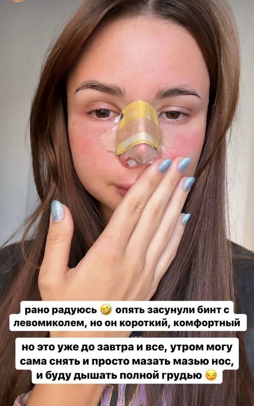 У Виктории Чуевой новый нос