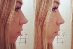 Ермакова: Помогите выбрать форму носа