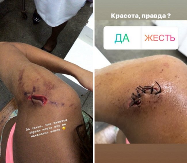 От редакции: Жарикова получила травму из-за Кварацхелия