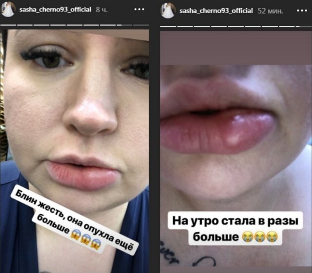 Черно ужаснула поклонников последствиями уколов красоты