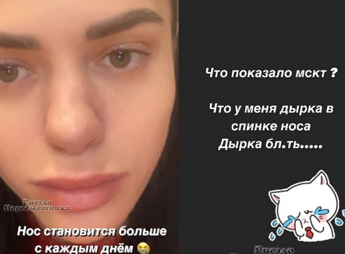 Анастасия Балинская: Нос становится все больше