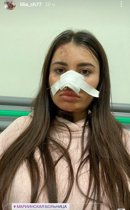 Лилия Четрару чуть не осталась без носа