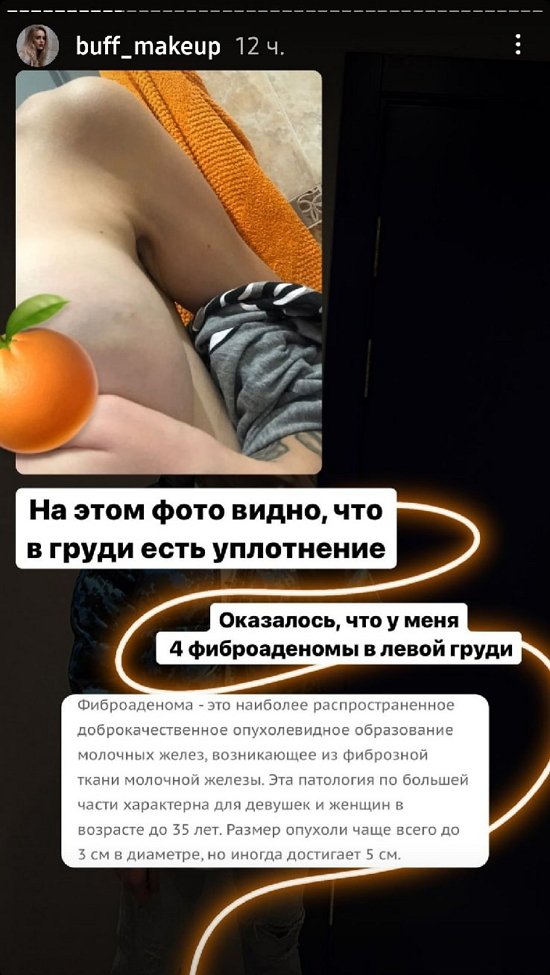 Милена Безбородова: У меня с детства были уплотнения в груди