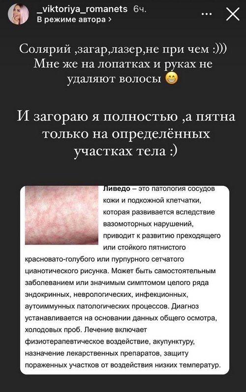 Виктория Романец: Они ещё больше становятся заметны