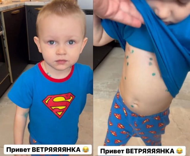 Алена Савкина: Привет, ветрянка!