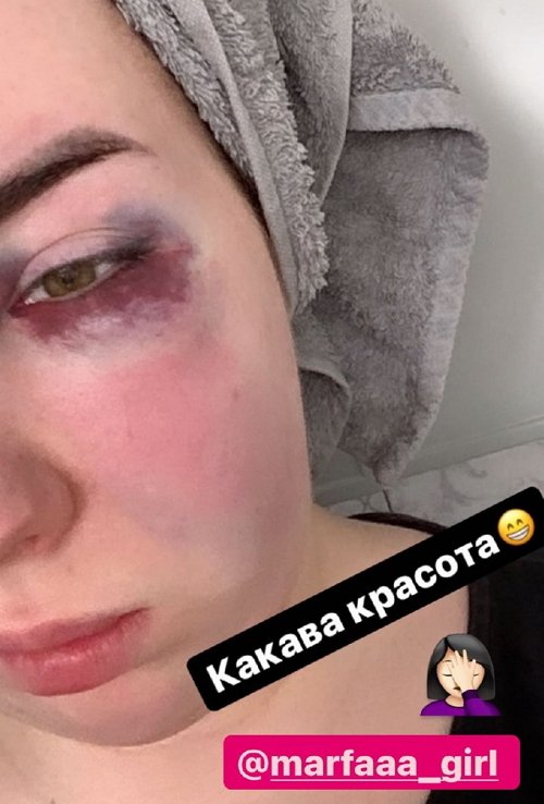 Сестра Александры Оганесян получила в глаз в драке в клубе