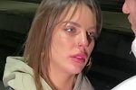 Алёна Опенченко неудачно накачала губы