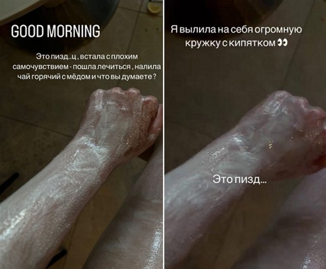 Алёна Савкина получила серьёзную травму
