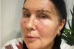 Татьяна Африкантова: Швы видны, но чувствую себя хорошо