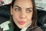 У Алёны Опенченко снова проблемы с кожей лица