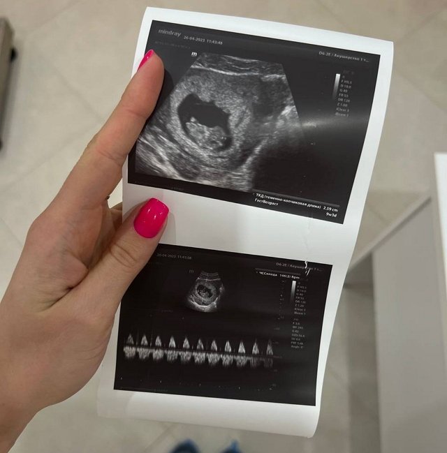 Елизавета Полыгалова: Срок 9 недель и 3 дня Елизавета Полыгалова: Срок 9 недель и 3 дня