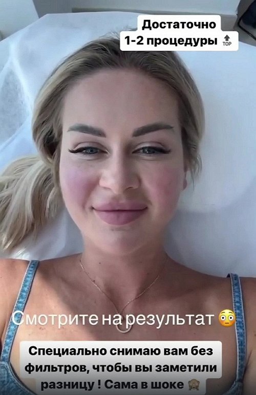 Марине Африкантовой сделали коррекцию щёк и подбородка
