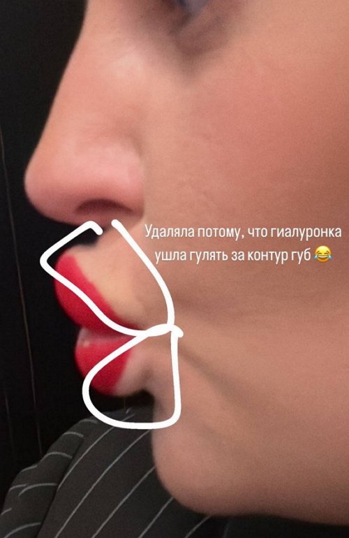 Майя Донцова избавилась от больших губ