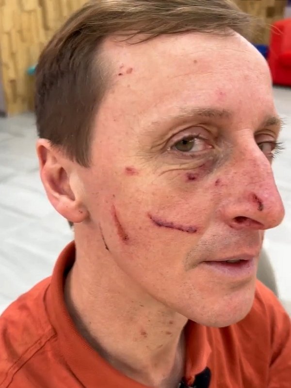 Вероника Гракович подпортила лицо своему мужу Альберту