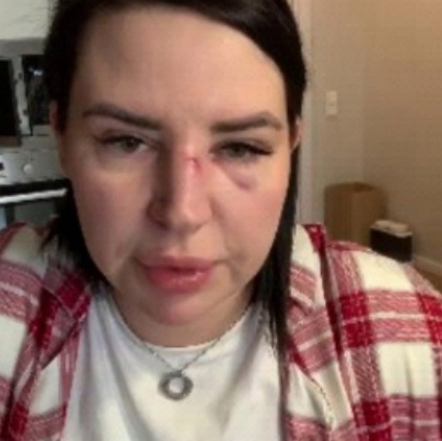 Александра Черно вышла в эфир с фингалом под глазом